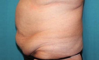 55-64 year old woman treated with CoolSculpting 3483199