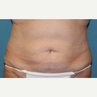 55-64 year old woman treated with CoolSculpting after 3483199