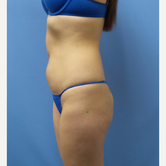 18-24 year old woman treated with Liposuction before 3378383