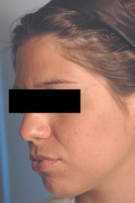 Photodynamic Therapy after 82956