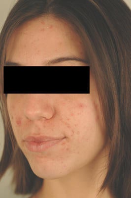 Photodynamic Therapy before 82956