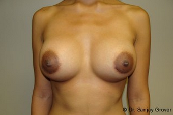 Breast Augmentation after 961341