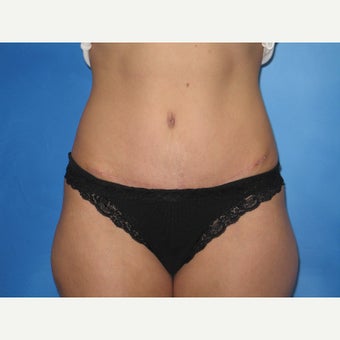 41 yr old female - Tummy Tuck with Liposuction of the Flanks after 2026880
