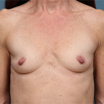 45-54 year old woman treated with Breast Augmentation before 3265149