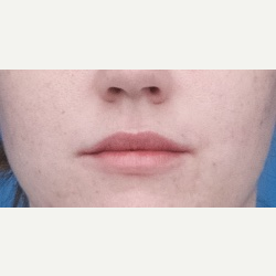18-24 year old woman treated with Restylane Silk after 3764360