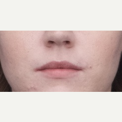 18-24 year old woman treated with Restylane Silk before 3764360