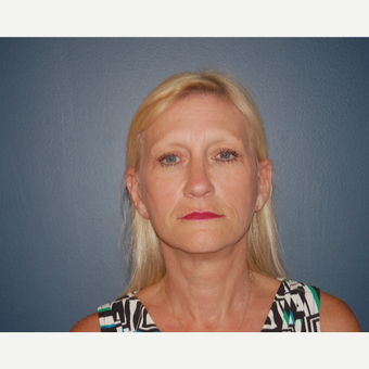 55-64 year old woman treated with Facelift after 3446703