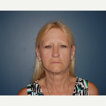 55-64 year old woman treated with Facelift before 3446703