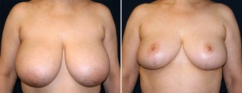 Breast Reduction before 996871