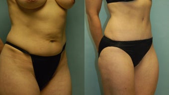 50 year-old woman one year after drainless tummy tuck and liposuction of the inner and outer thighs before 3261424