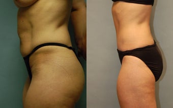 50 year-old woman one year after drainless tummy tuck and liposuction of the inner and outer thighs after 3261424