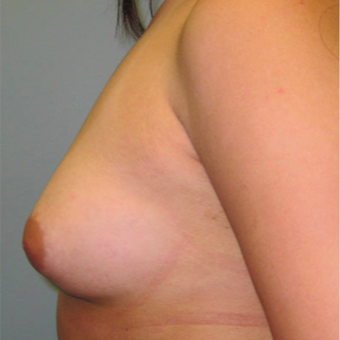 Breast Augmentation before 3467338