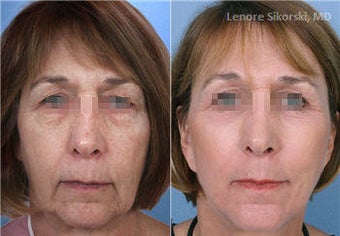 MiXto Laser Fractional Resurfacing - Upper Bleph & Facelift before 103909