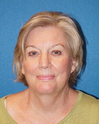 66 year old woman treated with Facelift 3576629