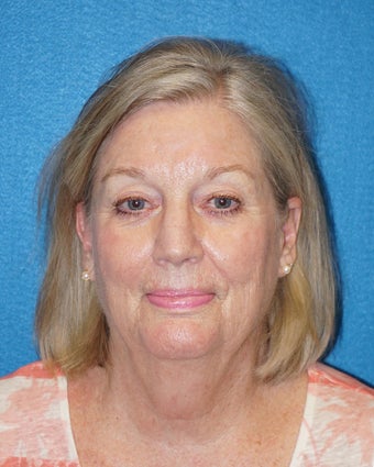 66 year old woman treated with Facelift 3576629