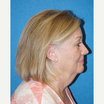 66 year old woman treated with Facelift before 3576629
