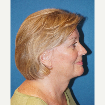 66 year old woman treated with Facelift after 3576629
