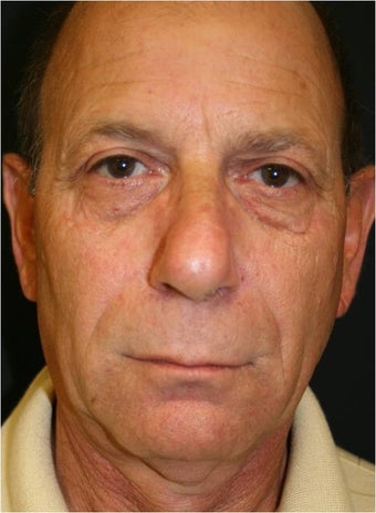 62 year old male treated with Sculpra injections for lost facial volume and skin sagging before 718315