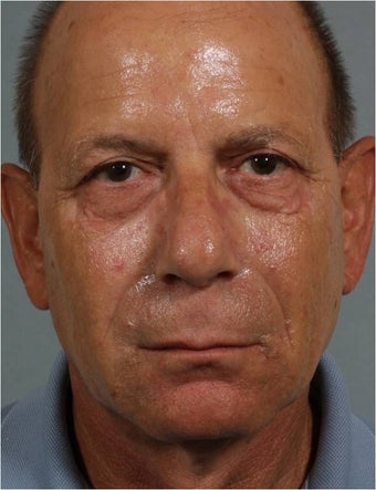 62 year old male treated with Sculpra injections for lost facial volume and skin sagging after 718315