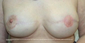 Revision of Reconstructed Breast after 527139