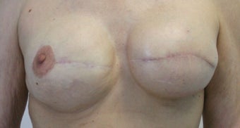 Revision of Reconstructed Breast before 527139