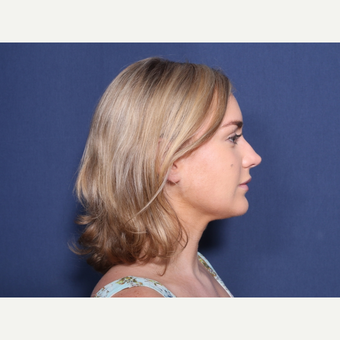 25-34 year old woman treated with Rhinoplasty (view 2 of 2) before 3781551