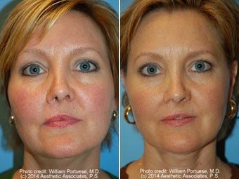 Neck Liposuction before 212295