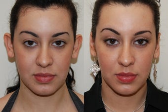 Otoplasty Surgery. 1 month post-op before 175093