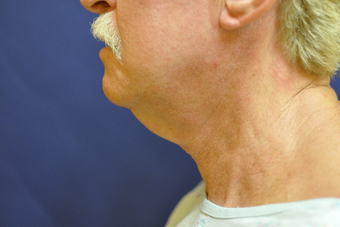 Law Liposuction and Ultherapy before 684529
