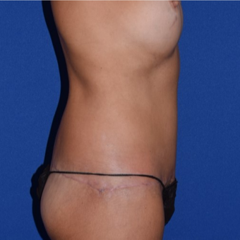 45-54 year old woman treated with No-Drain Body Lift after 3755270