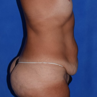45-54 year old woman treated with No-Drain Body Lift before 3755270