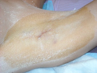 Removal of axillary sweat glands for axillary hyperhidrosis after 231260