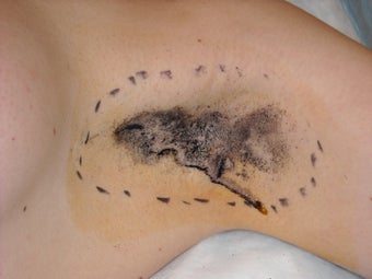 Removal of axillary sweat glands for axillary hyperhidrosis before 231260