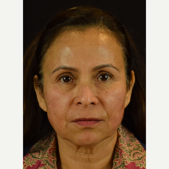 Enhancement of the Midface and Lower Third with Novathreads – Non-Surgical Rejuvenation after 3583022