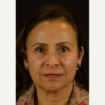 Enhancement of the Midface and Lower Third with Novathreads – Non-Surgical Rejuvenation before 3583022