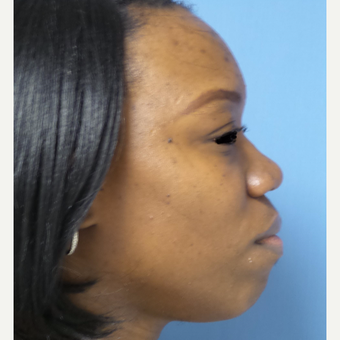 35-44 year old woman treated with African American Rhinoplasty before 3169285