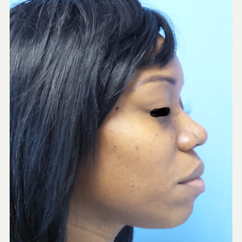35-44 year old woman treated with African American Rhinoplasty after 3169285