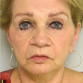 65-74 year old woman treated with Juvederm before 2113052