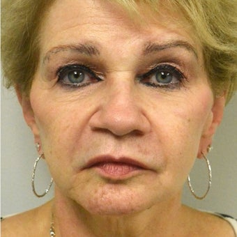 65-74 year old woman treated with Juvederm after 2113052