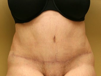 55-64 year old woman treated with Tummy Tuck after 1762281