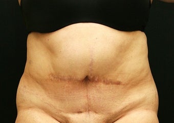 55-64 year old woman treated with Tummy Tuck before 1762281