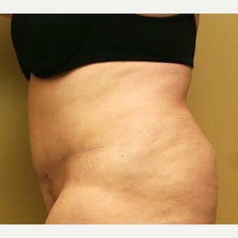 55-64 year old woman treated with Tummy Tuck 1762281