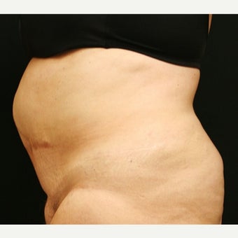 55-64 year old woman treated with Tummy Tuck 1762281