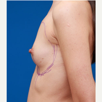 25-34 year old woman treated with Breast Augmentation before 3167743