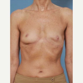 45-54 year old woman treated with Breast Fat Transfer before 2286240