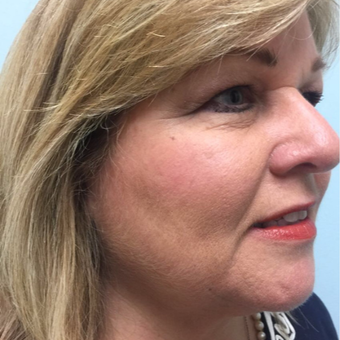 57 year old patient treated with Kybella after 2851428