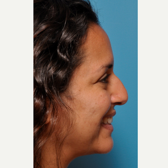 Minor Changes Showing Significant Nasal Improvement before 3524135