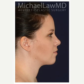 25-34 year old woman treated with Lower Face Lift after 3383331