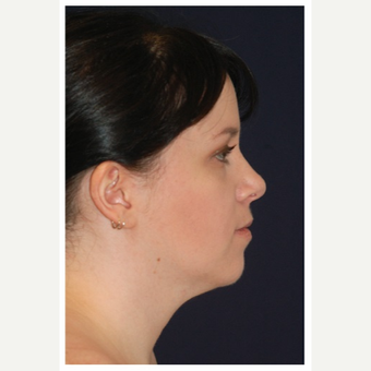 25-34 year old woman treated with Lower Face Lift before 3383331