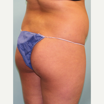 18-24 year old woman treated with Smart Lipo before 3437459